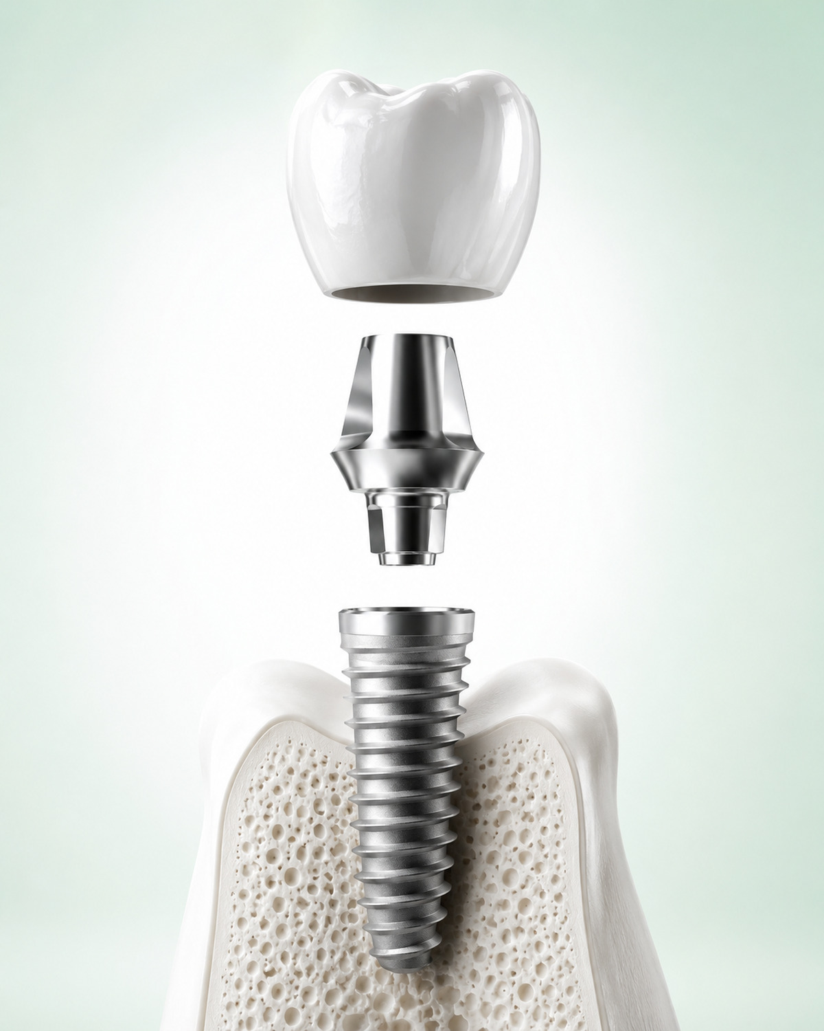 Implantes Dentários